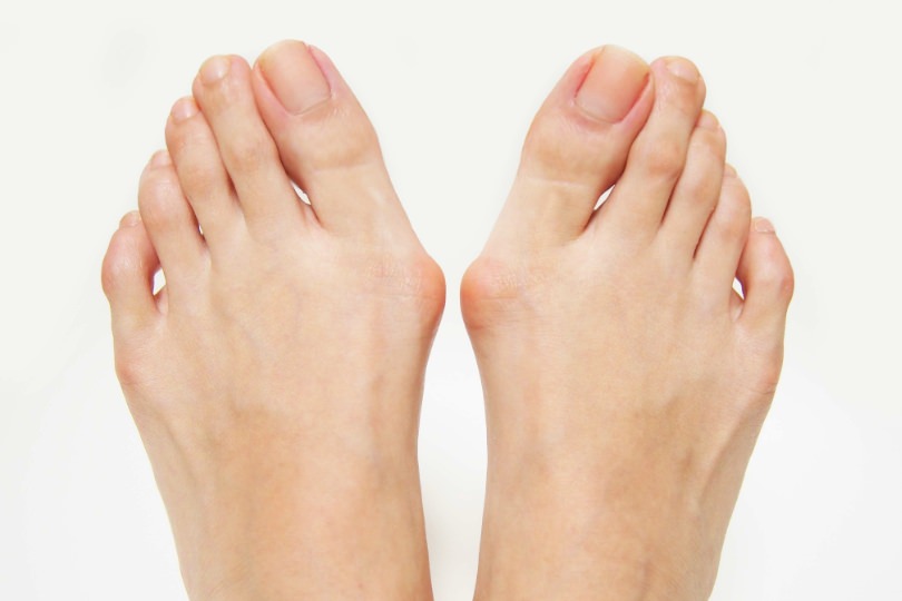 そもそも外反母趾とは？