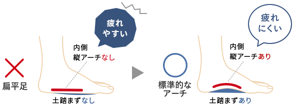 扁平足→正常な足