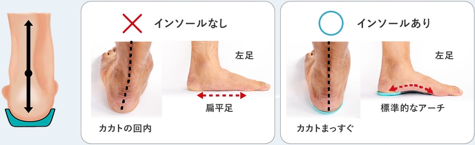 カカトの回内を防止