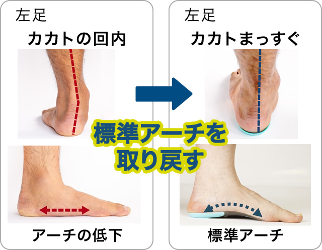 カカトの回内→カカトまっすぐ「標準アーチを取り戻す」
