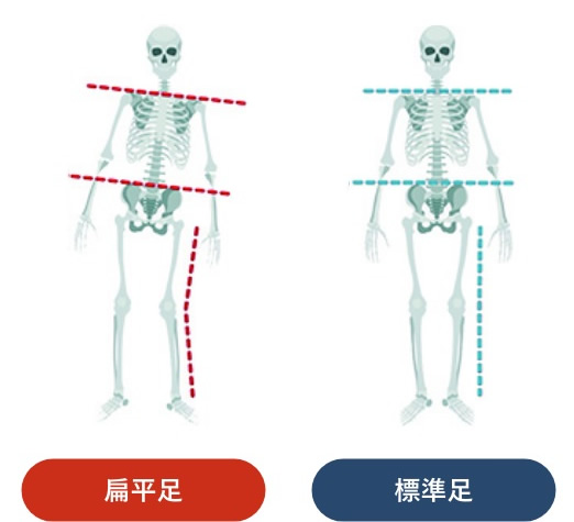 扁平足／標準足